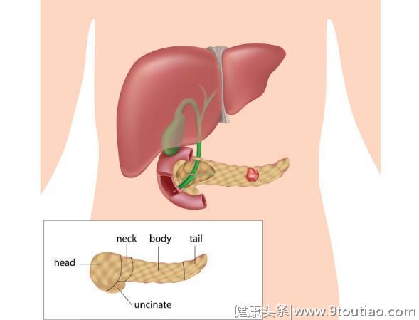 这种病易被当成胃病，若有这5种特征，警惕胰腺癌，需及时检查