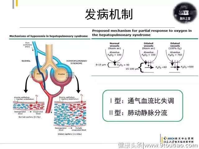 慢性肝病相关性肺血管病