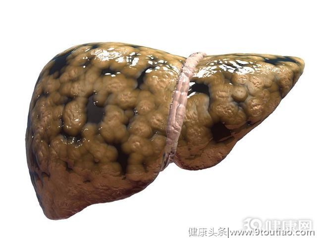  大多数人查出脂肪肝，常与4个因素有关，其实可避开