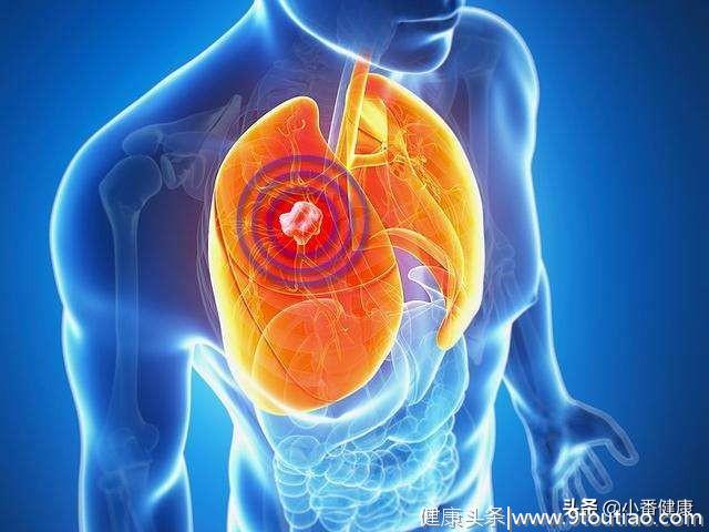 肺癌高居全球恶性肿瘤发病率第一