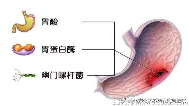 从胃炎到胃癌，仅仅只有4步