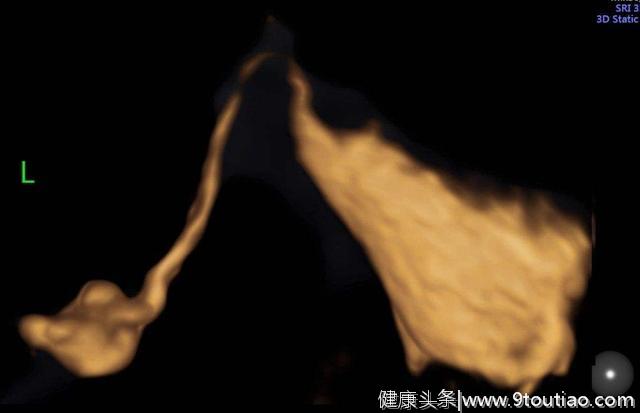 告别X光辐射和碘油过敏，选择子宫输卵管四维超声高清造影