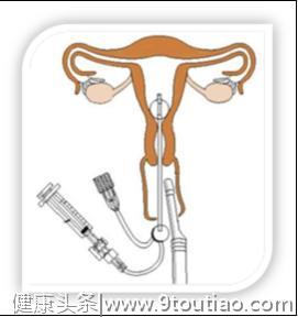 告别X光辐射和碘油过敏，选择子宫输卵管四维超声高清造影