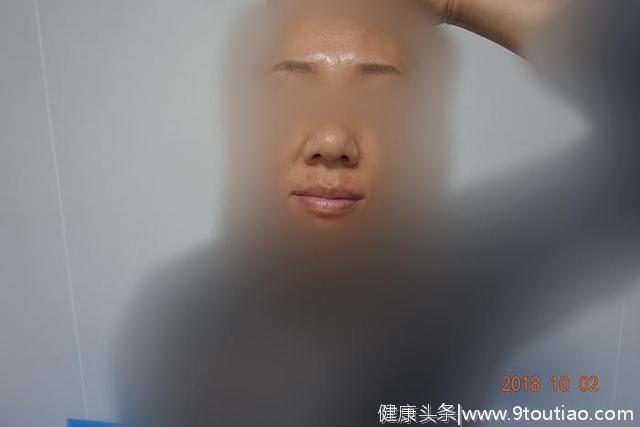 白癜风患者真实案例分析：37岁患者面部白斑治疗周期图片对比