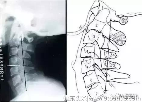 图文并茂 | 详细的颈椎X线解剖+解读