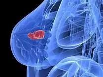 新的药物可将晚期乳腺癌存活率提高30％