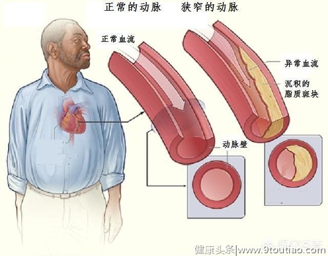 冠心病能被治愈？别被忽悠了！