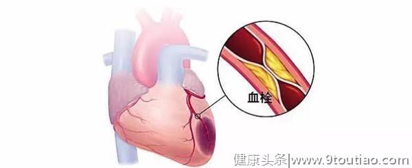 冠心病能被治愈？别被忽悠了！