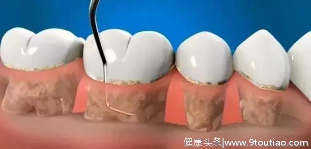 为什么洗牙要将牙龈翻开？