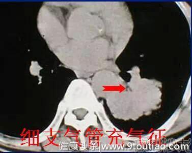 肺癌常见的七大CT影像特征