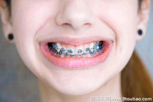 儿童矫正牙齿，一定要等到12岁吗？