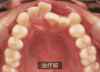 牙医牙医，我听说…金属烤瓷牙是有毒的？