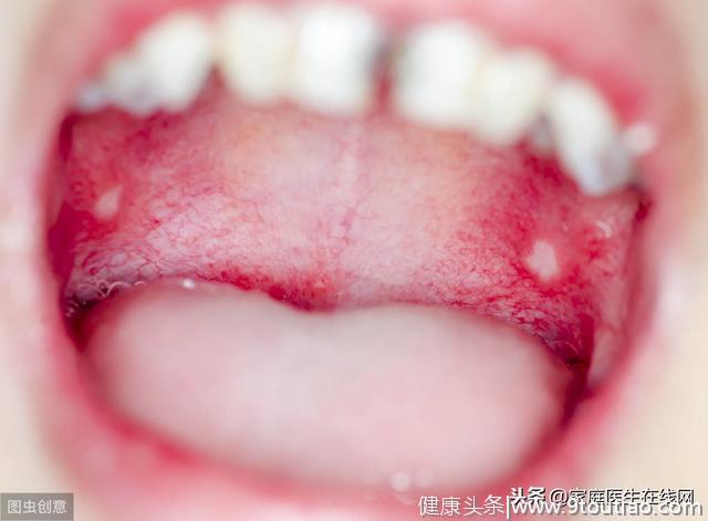 口里总是爱长泡，可能口腔“惹恼”了5种疾病，别大意