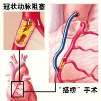 冠心病的科普文章，这一篇是最精美，最简洁易懂的