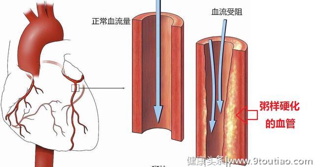 冠心病的科普文章，这一篇是最精美，最简洁易懂的