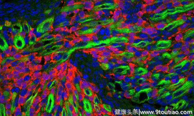 研究人员发现，“肌肉”癌症并不是真正的肌肉癌症