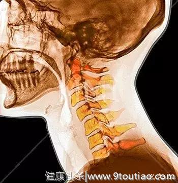 图谱--颈椎退行性改变