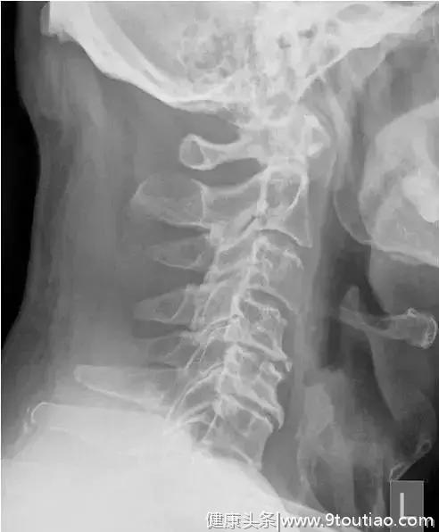 图谱--颈椎退行性改变