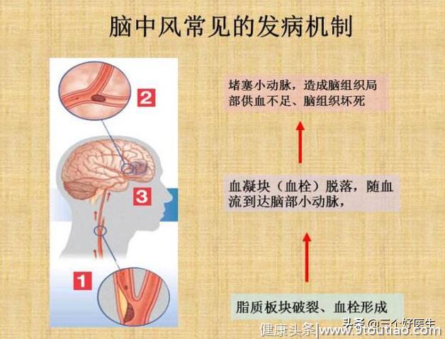 中风的元凶原来是“颈椎”