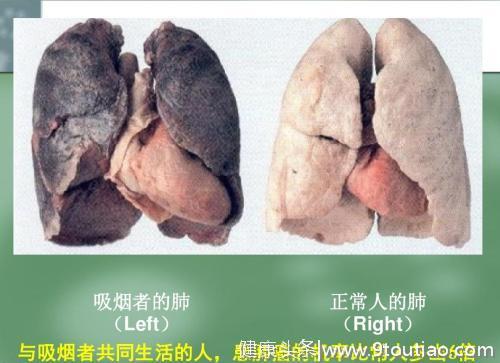 长期抽烟的你已经被列为肺癌候选人了