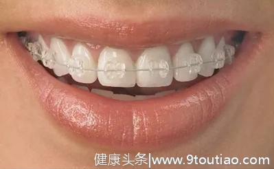 6种牙齿矫正方式，总有一种适合你
