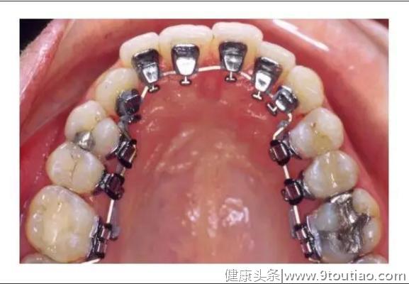 6种牙齿矫正方式，总有一种适合你