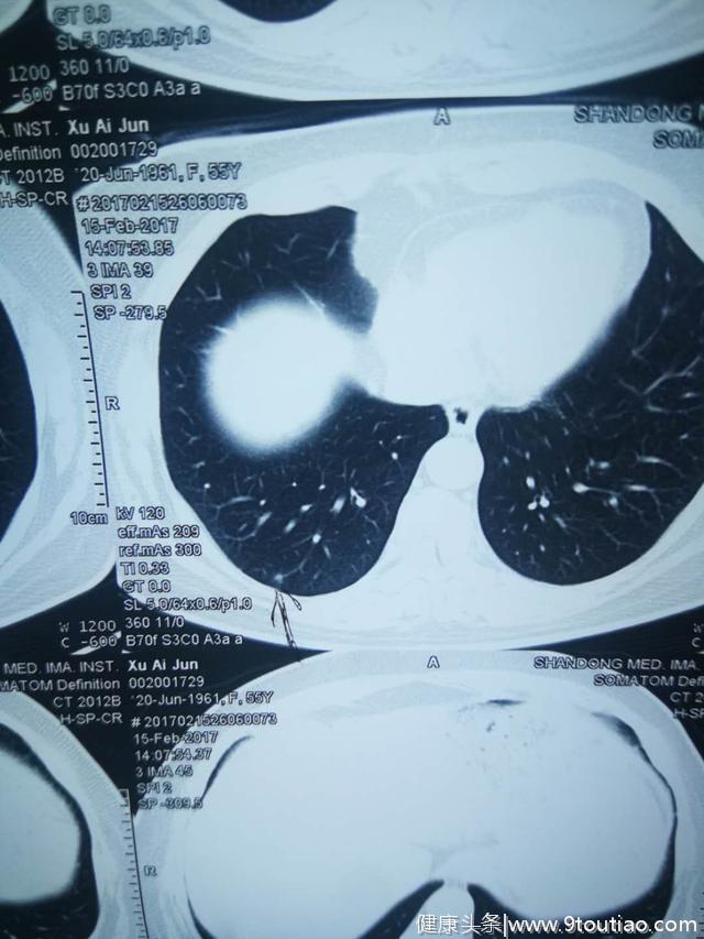 CT照出肺结节，是不是得了肺癌？医生终于说了大实话