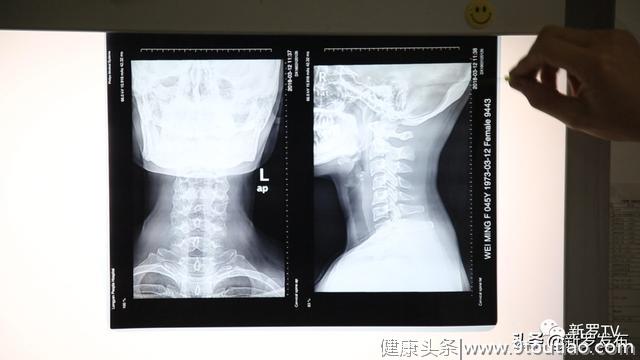 颈椎病呈年轻化趋势，龙岩人民医院医生教你如何预防和治疗