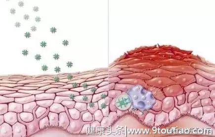 中医思维：中医特色疗法治疗带状疱疹