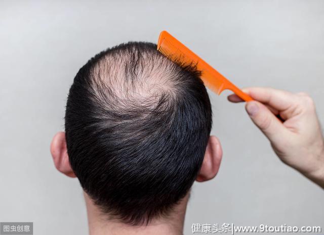 植发已成年轻人中的潮流，男性脱发高达20%。怎么回事？