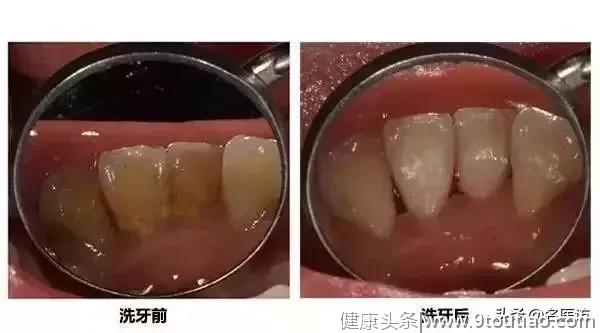 洗牙真的会导致牙缝变宽牙齿松动吗？牙医告诉你真相