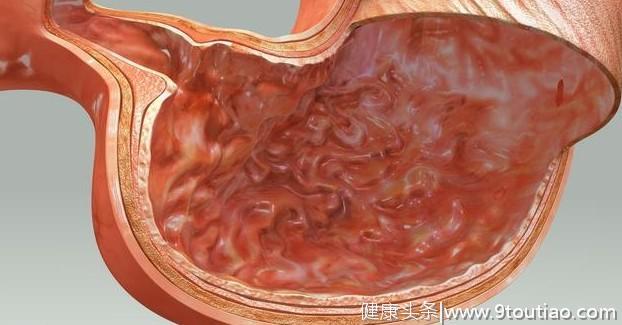 24岁女孩确诊胃癌，医生：胃癌"祸根"找到了，3种食物最好少吃
