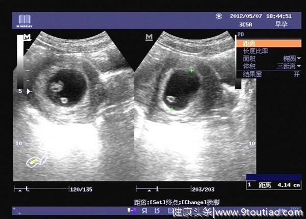 怀孕5-8周胎儿有“人”样，孕妇妊娠反应大，避免胎儿畸形是关键