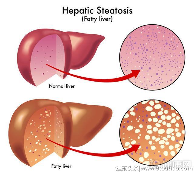 4个原因是脂肪肝的“帮手”，为了肝脏健康，请尽早避开
