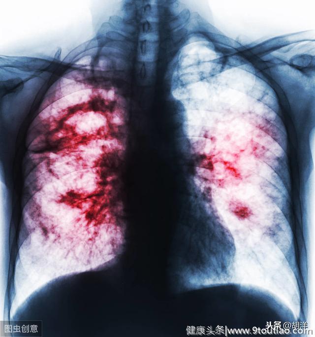 哪些表现提示肺部病了，7大症状必须要当心，最后一点可能是肺癌