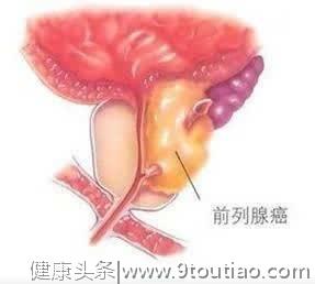 男人要呵护你的前列腺