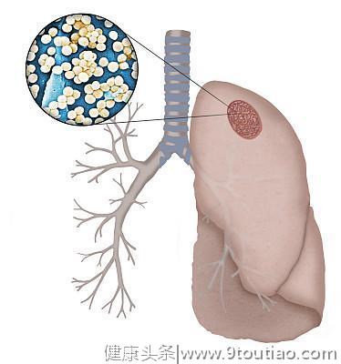 24岁小伙，肺癌晚期，病床上等死，为什么能换肾却不能换肺？