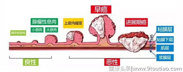 庆幸！宜宾男子只因听了医生的这句话！与肠癌擦身而过