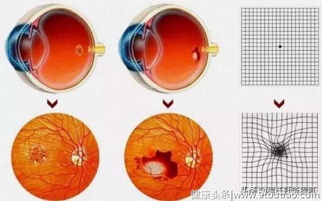 答疑解惑 | 针灸能治疗黄斑变性吗，如何选穴处方？