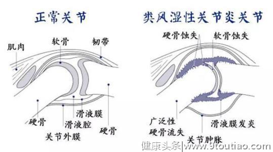 得了类风湿关节炎千万不要忽视，缓解治疗可以降低80%心血管风险