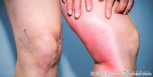 注意15种常见病可以引起腿疼