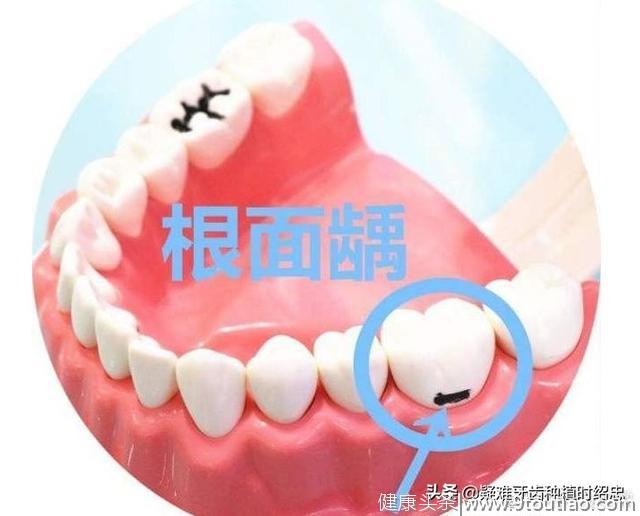 牙总是从牙齿根部烂掉是怎么回事？