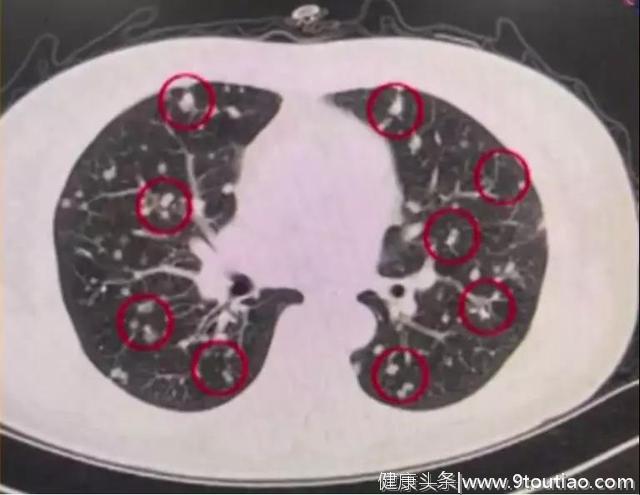 体检查出肺部小结节？专家告诉你小结节离肺癌究竟有多远