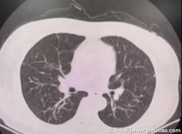 体检查出肺部小结节？专家告诉你小结节离肺癌究竟有多远