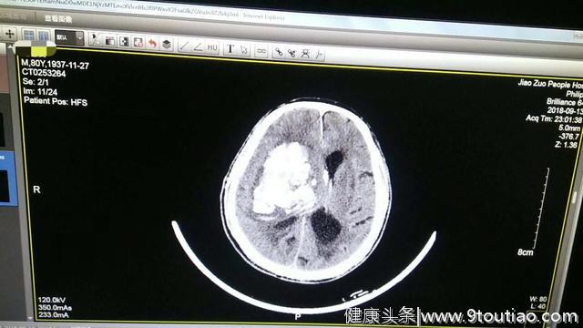 什么情况下高血压病人可以停药？