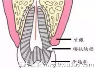 这么刷牙，牙齿真的会断的