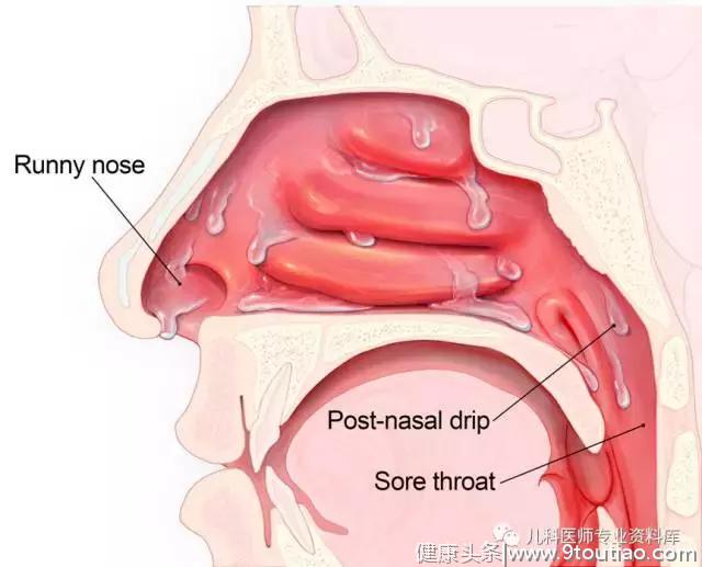 儿童过敏性鼻炎，一文搞定