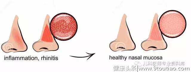 儿童过敏性鼻炎，一文搞定