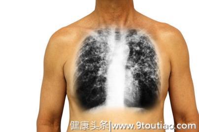 肺癌上身并非悄无声息，医生警示：身体若出现“3黑2红”，快检查