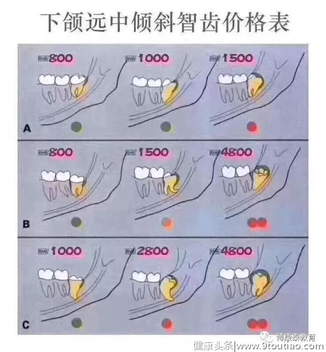 为啥拔智齿收费差别这么大？看了这3张图你就明白了